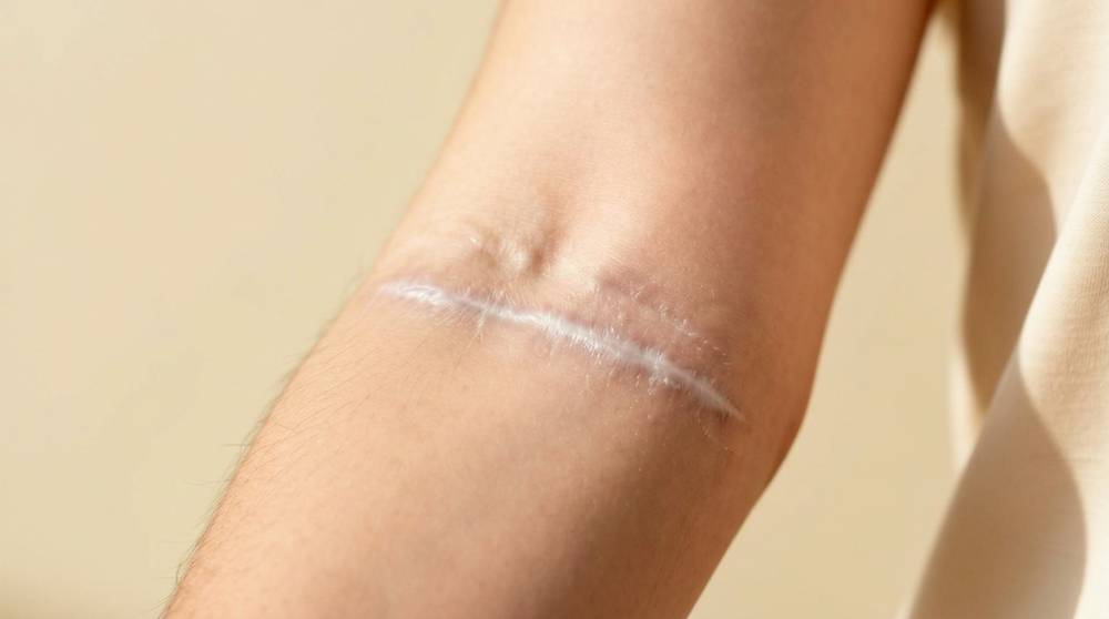 Healed scar camouflage paramedical tattooing at Ink Clinic Modesto.