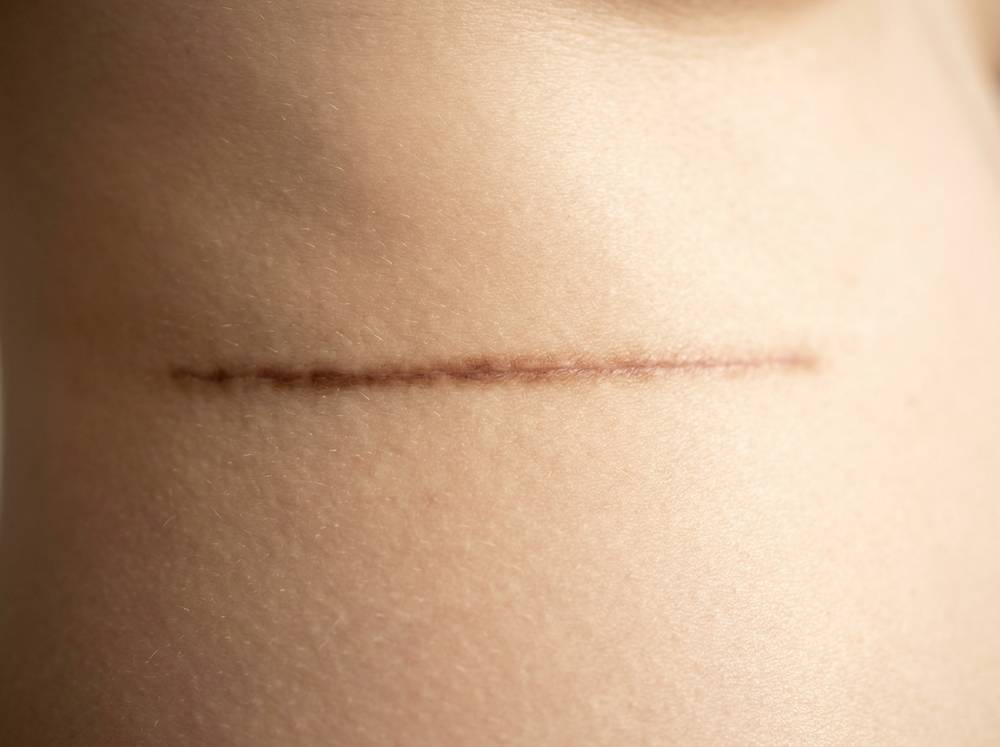 Scar Neutralization example at Ink Clinic Modesto.